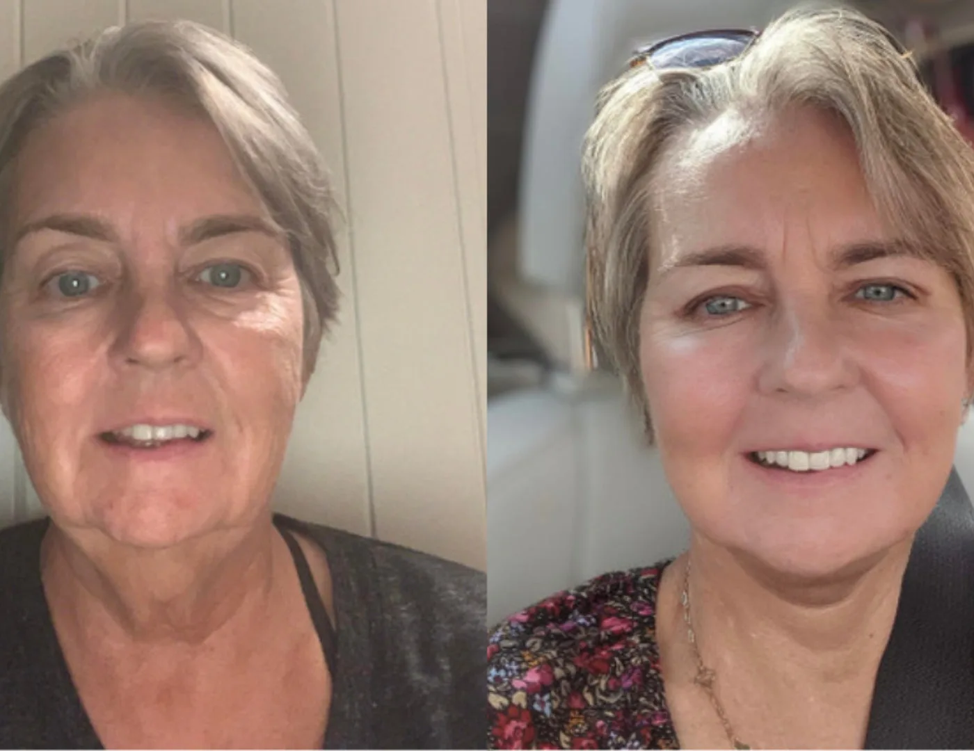 Antes y después Mariana W.