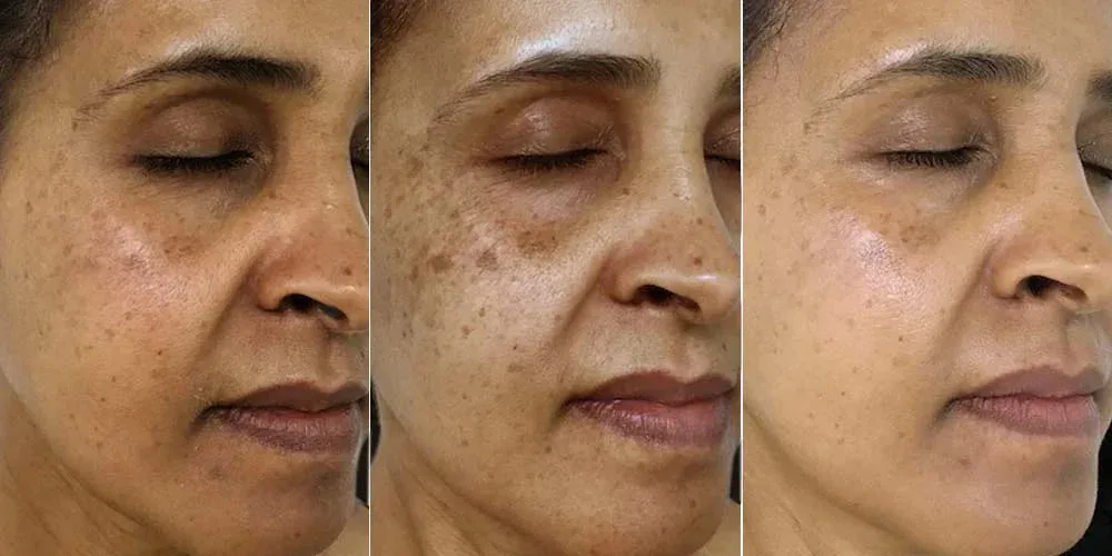 Suero Corrector de Manchas Oscuras con Vitamina C para Hiperpigmentación, Melasma y Marcas de Acné en Rostro y Manos