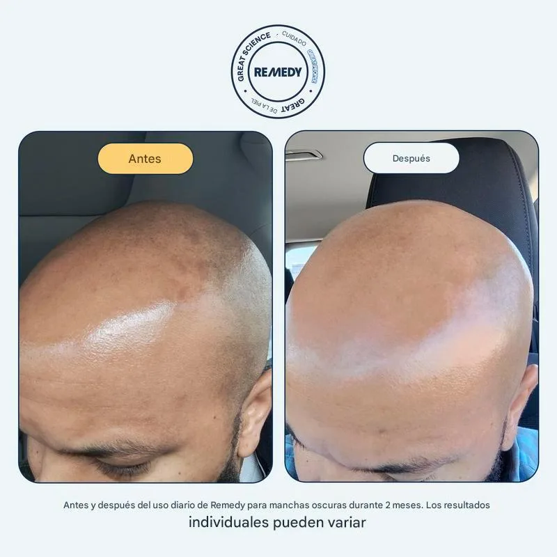Sérum puntos negros