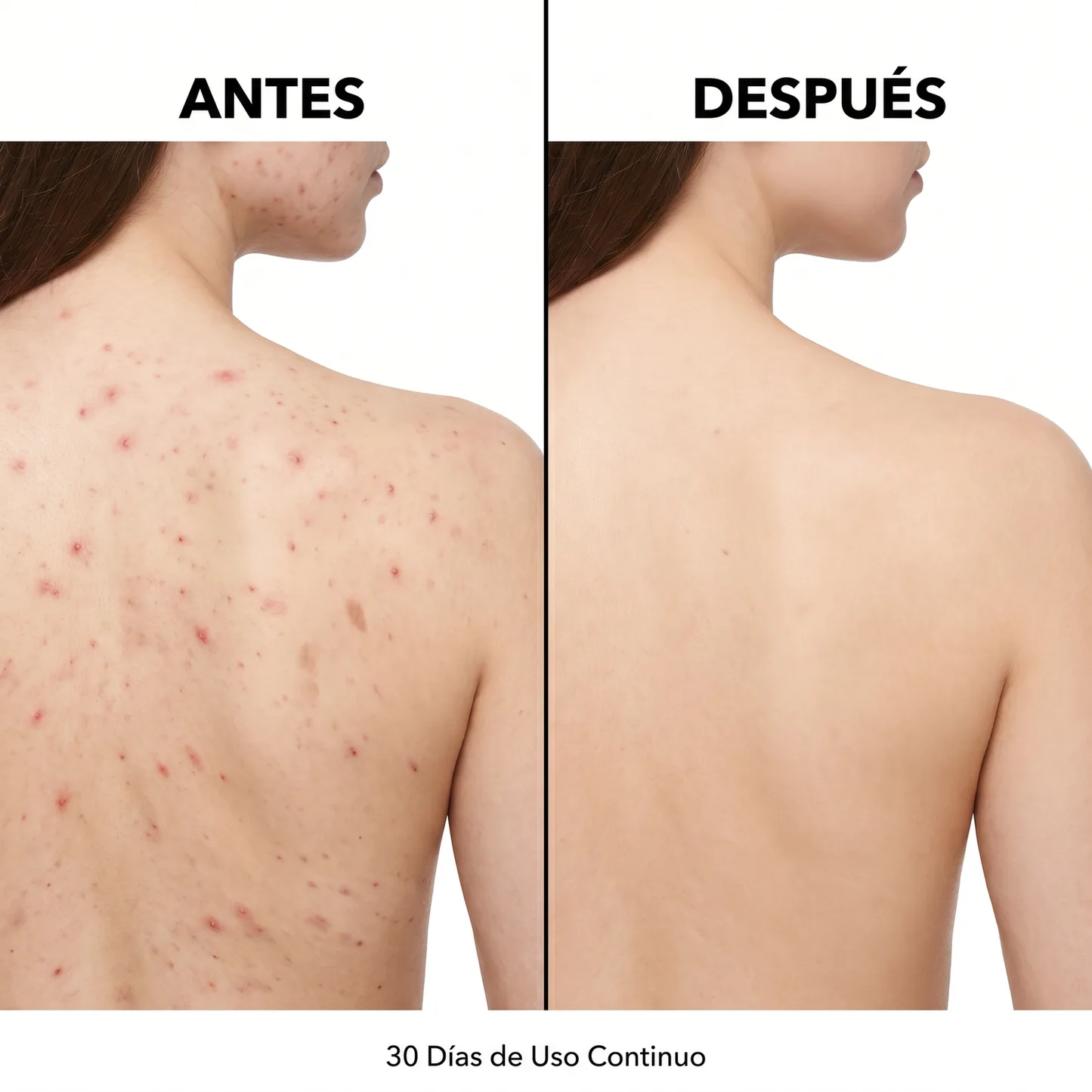 InfiniteClear - Limpiador Corporal Anti-Acné