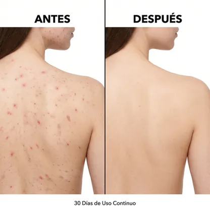 InfiniteClear - Limpiador Corporal Anti-Acné