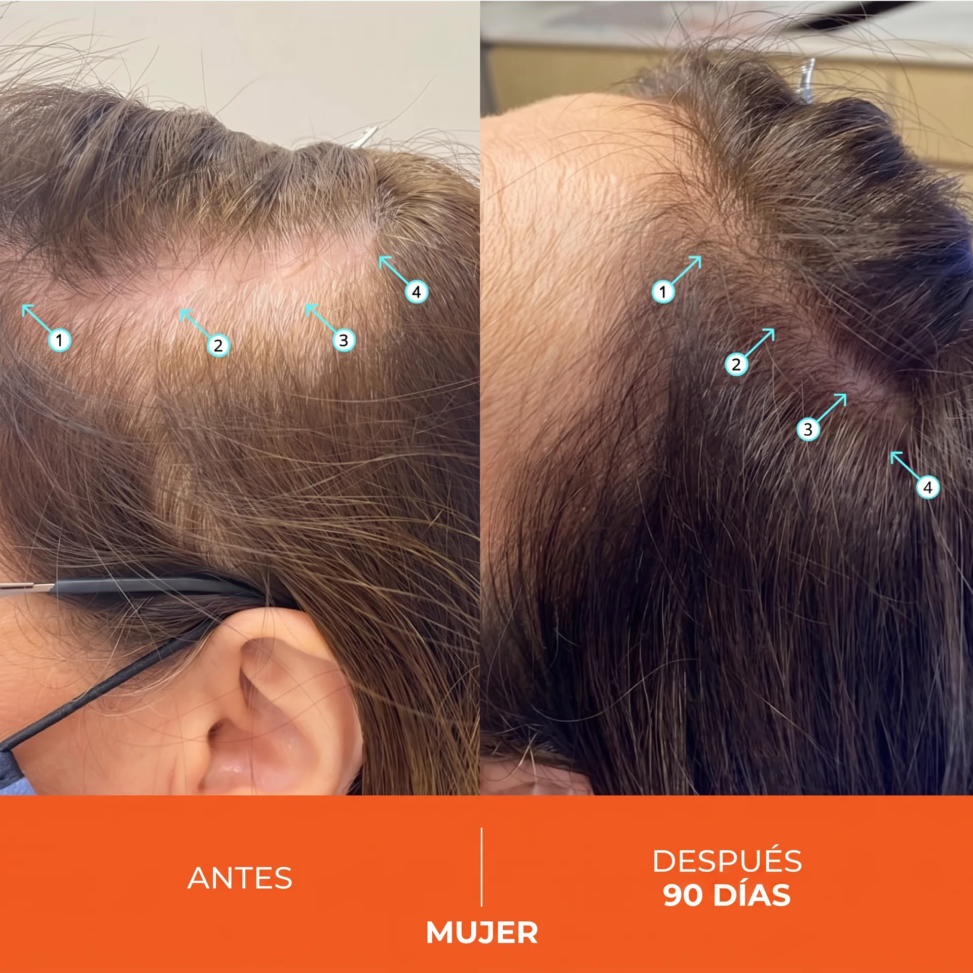 Antes y Después Mujer 90 Días