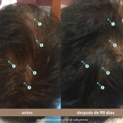 Sérum de Densidad Capilar para Hombre con Nanoxidil 5% — Anticaída 60 ml